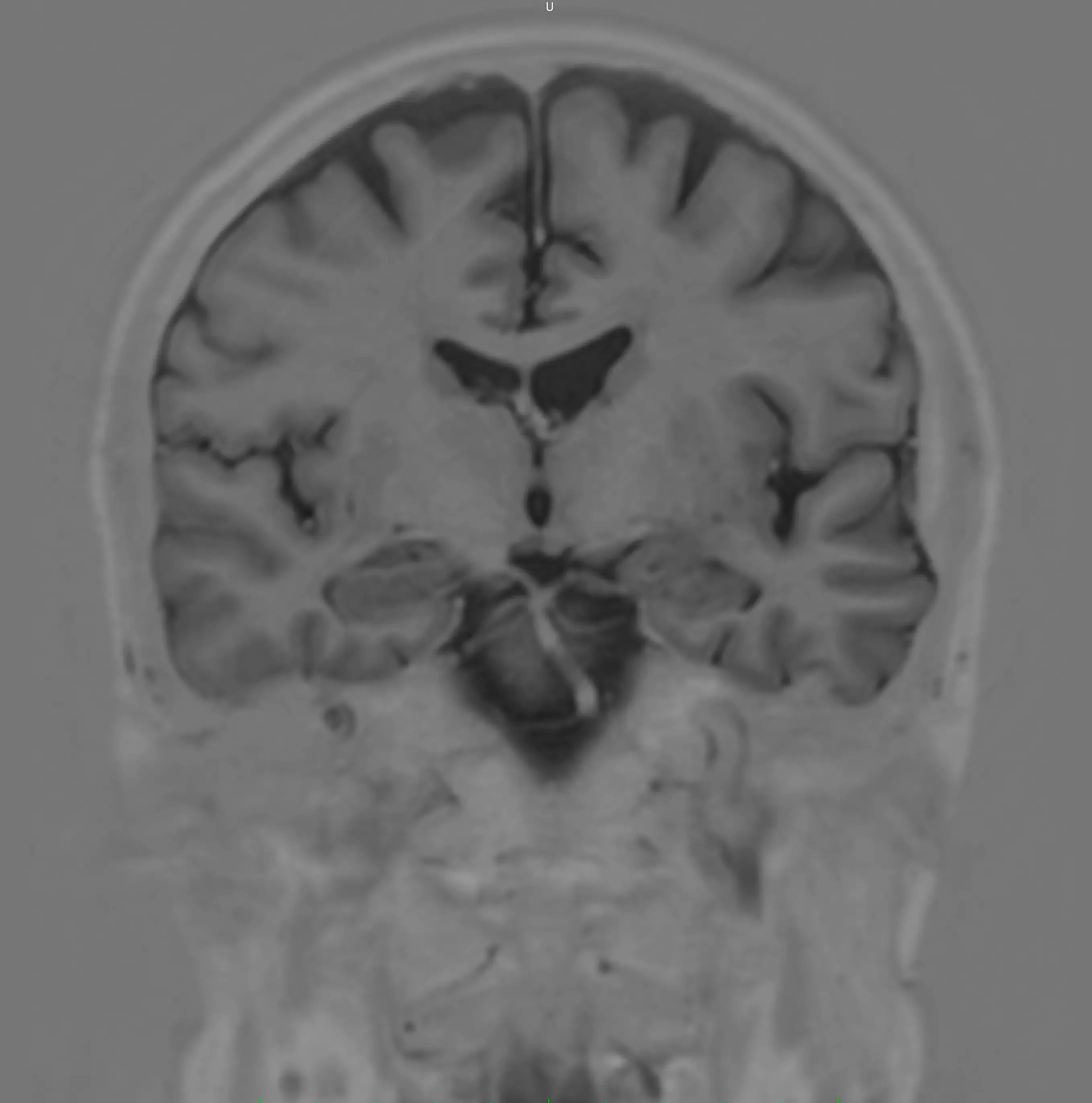 МРТ головного мозку